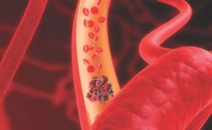 Available Now: New Webinar on Venous Thromboembolism (VTE) from the American College of Emergency Physicians